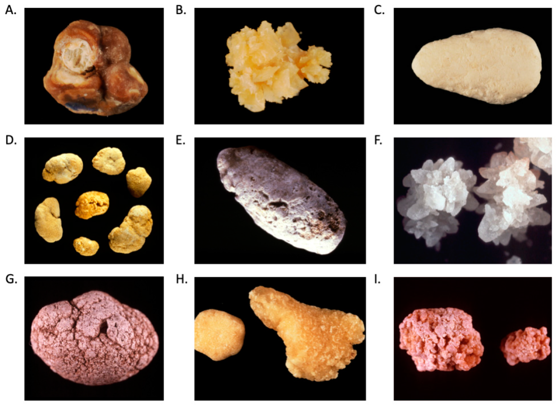 Types of Kidney Stones: Causes, Composition & Treatment Differences