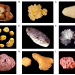 Types of Kidney Stones: Causes, Composition & Treatment Differences