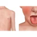 Strep Throat Complications: Scarlet Fever, Abscess, and Kidney Issues