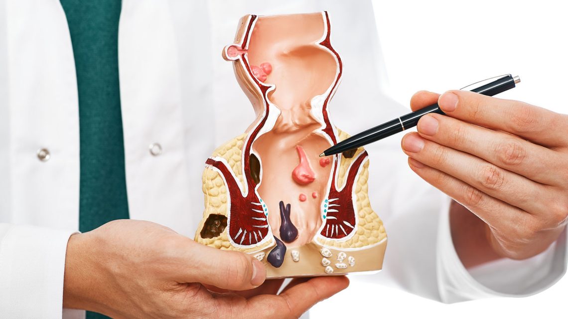 Preventing Hemorrhoids: Diet, Hydration, and Bathroom Habits