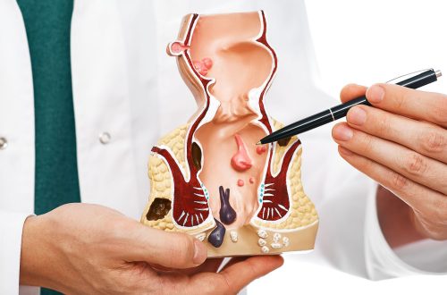 Preventing Hemorrhoids: Diet, Hydration, and Bathroom Habits