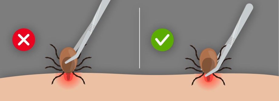 How to Properly Remove a Tick
