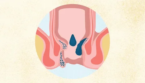 Internal vs. External Hemorrhoids: Symptoms, Differences, and Treatments