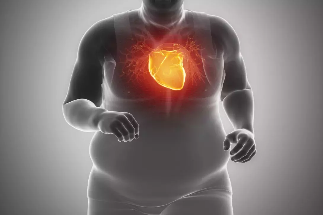 Health Risks of Obesity: Beyond Weight (Diabetes, Heart Disease, Cancer)