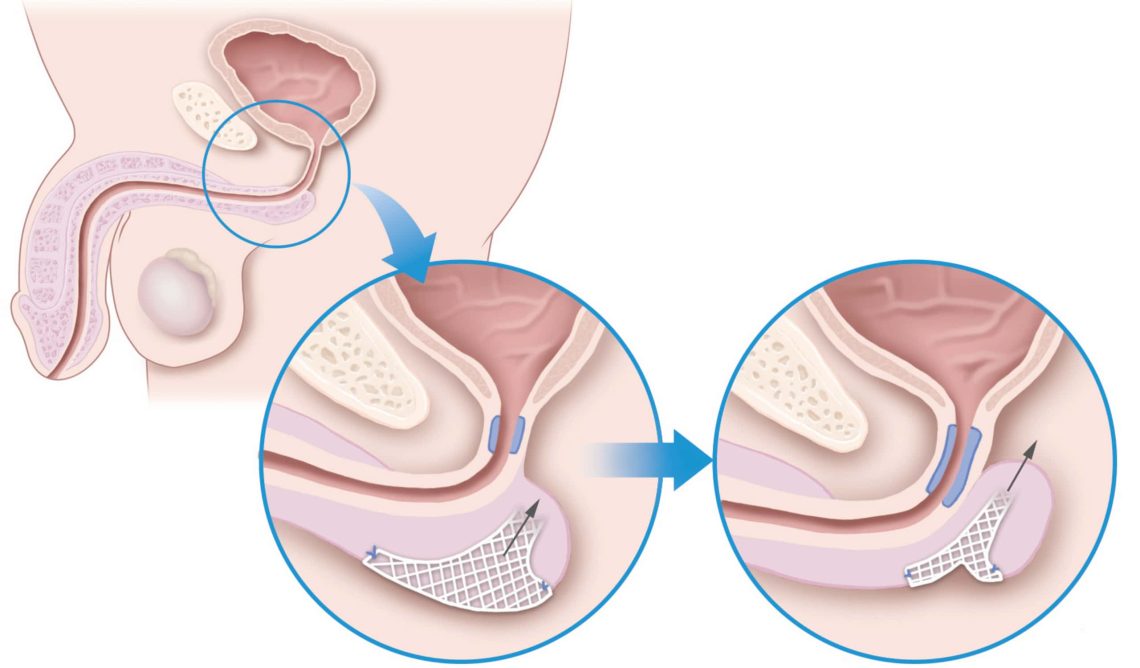 Incontinence After Childbirth or Prostate Surgery