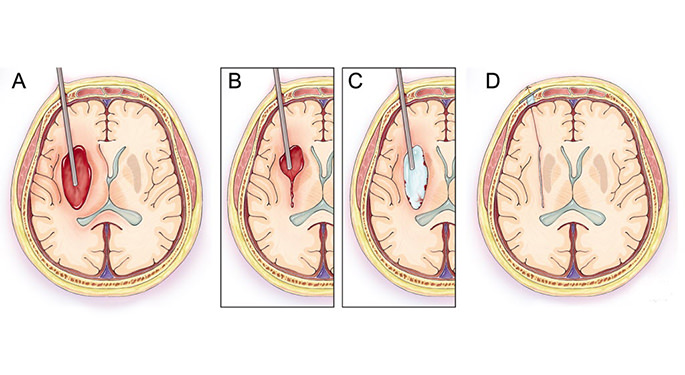 Ischemic vs. Hemorrhagic Stroke: Causes and Treatments