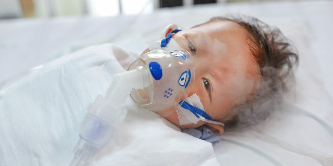 Long-Term Effects of Severe RSV in Infancy