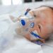 Long-Term Effects of Severe RSV in Infancy