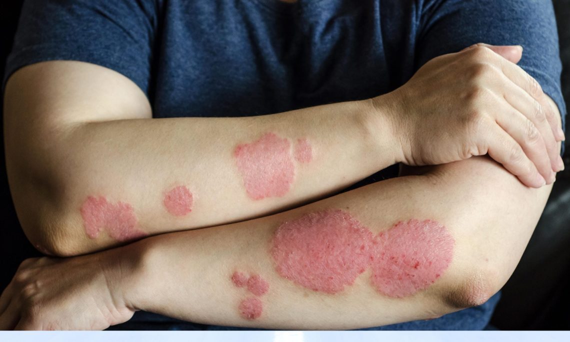 Contact Dermatitis: Identifying Triggers (Poison Ivy, Nickel, Fragrances)