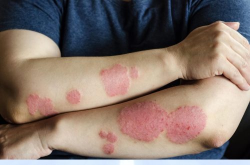 Contact Dermatitis: Identifying Triggers (Poison Ivy, Nickel, Fragrances)