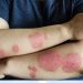 When a Rash Needs Urgent Care (Stevens-Johnson, Cellulitis Signs)