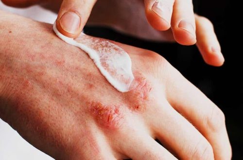 Eczema (Atopic Dermatitis) Management: Moisturizing, Triggers, Medications