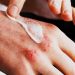 Eczema (Atopic Dermatitis) Management: Moisturizing, Triggers, Medications