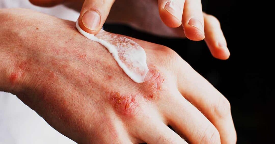 Eczema (Atopic Dermatitis) Management: Moisturizing, Triggers, Medications