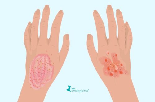 Common Rash Identification Guide : Eczema, Psoriasis, Hives, etc.