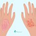 Common Rash Identification Guide : Eczema, Psoriasis, Hives, etc.