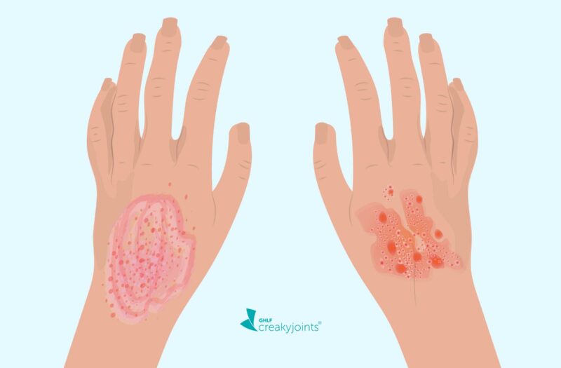 Common Rash Identification Guide : Eczema, Psoriasis, Hives, etc.