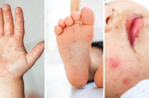 Viral Rashes in Children (Chickenpox, Roseola, Hand Foot Mouth)