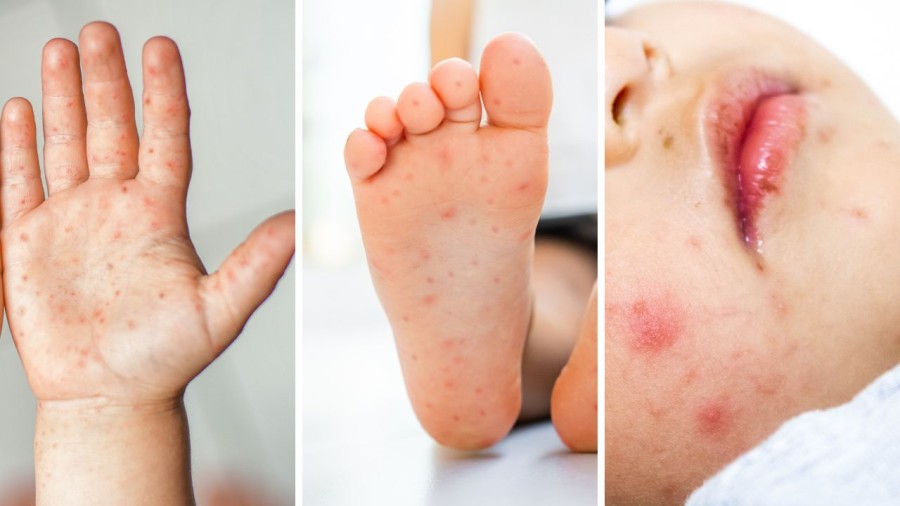 Viral Rashes in Children (Chickenpox, Roseola, Hand Foot Mouth)