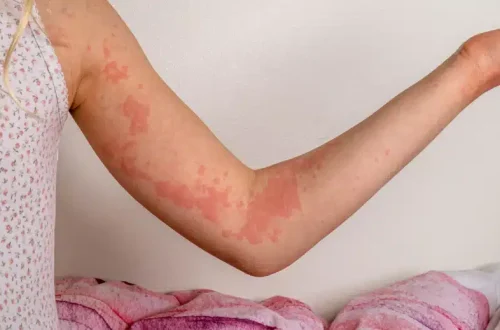Hives (Urticaria): Causes (Allergies, Stress) and Antihistamine Use