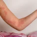 Hives (Urticaria): Causes (Allergies, Stress) and Antihistamine Use