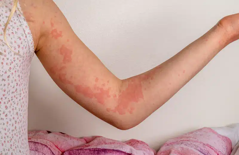 Hives (Urticaria): Causes (Allergies, Stress) and Antihistamine Use