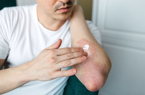 Psoriasis Types and Treatments: Topicals, Light Therapy, Biologics