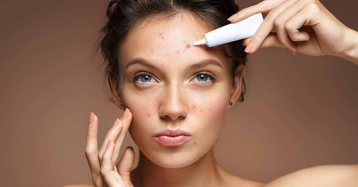 The Role of Hormones in Acne and Treatment Implications