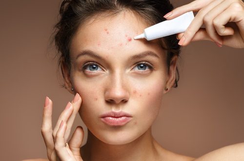 The Role of Hormones in Acne and Treatment Implications
