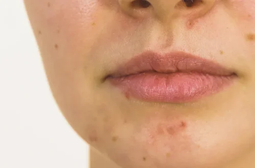 Acne in Adults: Causes and Specific Treatment Approaches