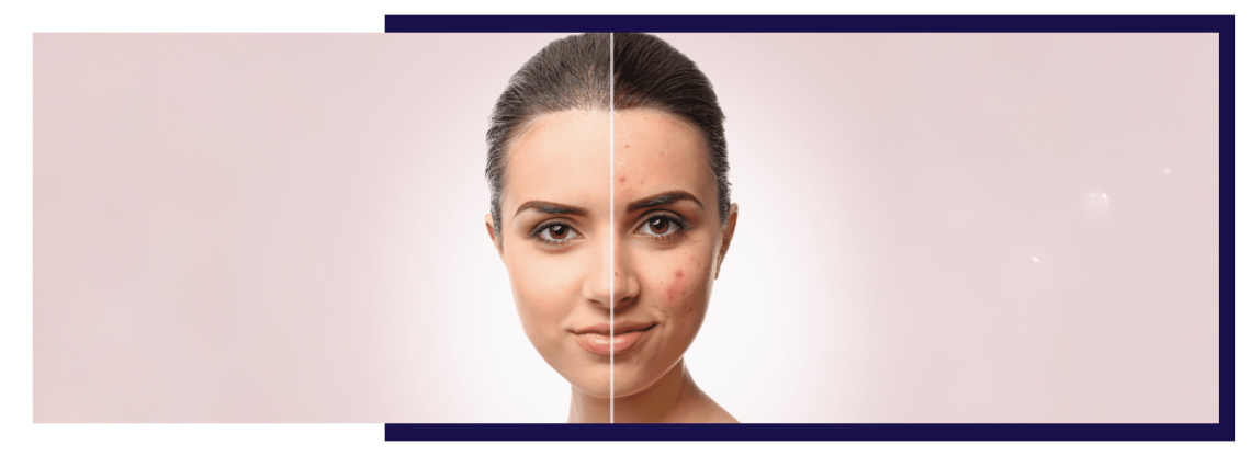 Managing Acne Scarring: Prevention and Treatment Options