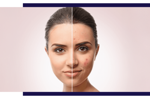 Managing Acne Scarring: Prevention and Treatment Options