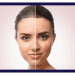 Managing Acne Scarring: Prevention and Treatment Options