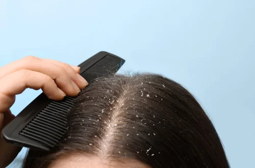 Dry Scalp vs. Dandruff: How to Tell the Difference (Crucial for Treatment)
