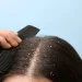 Dry Scalp vs. Dandruff: How to Tell the Difference (Crucial for Treatment)