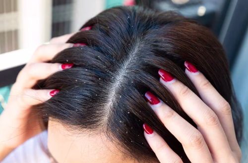 Preventing Dandruff Recurrence: Maintenance Strategies