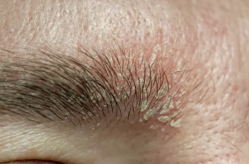 Managing Dandruff in Beards and Eyebrows