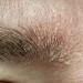 Managing Dandruff in Beards and Eyebrows