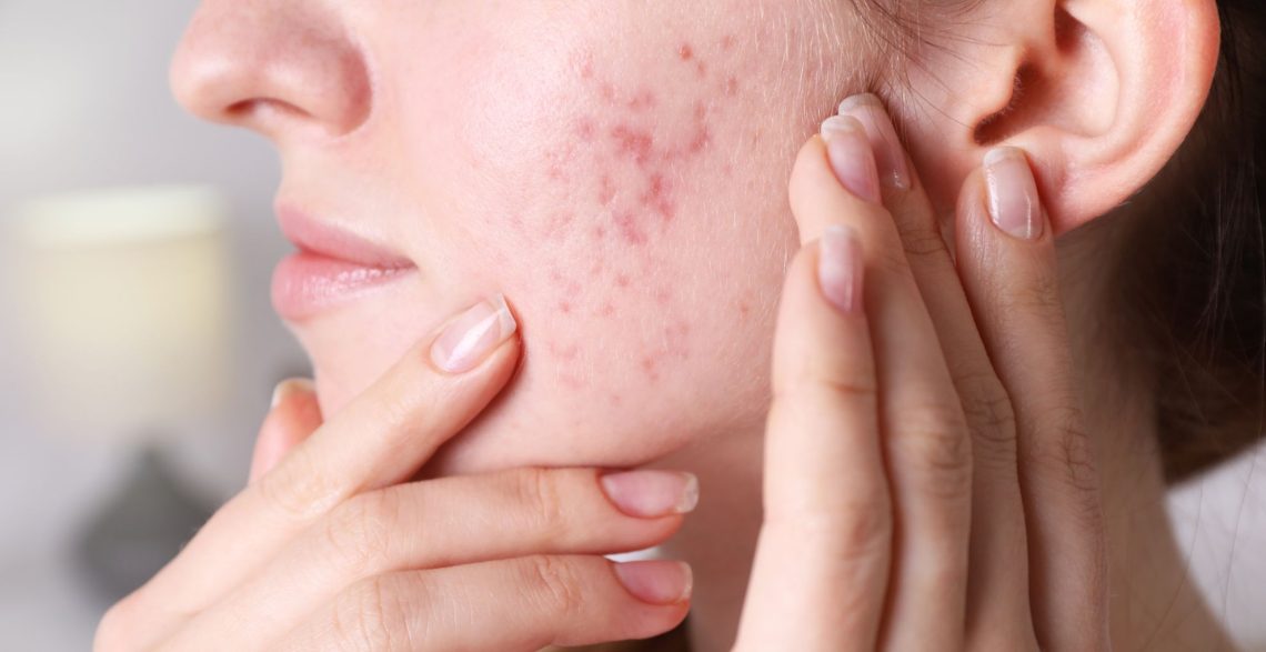 Dealing with Under-the-Skin (Cystic) Pimples