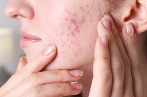 Hormonal Pimples: Understanding the Cycle and Management