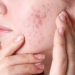 Hormonal Pimples: Understanding the Cycle and Management
