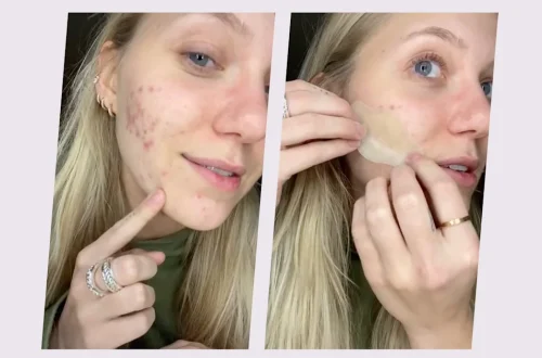 Pimple Patches/Hydrocolloid Bandages: How They Work