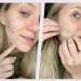 Pimple Patches/Hydrocolloid Bandages: How They Work