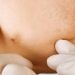 Dealing with Under-the-Skin (Cystic) Pimples