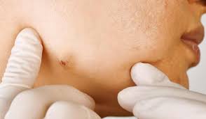 Dealing with Under-the-Skin (Cystic) Pimples