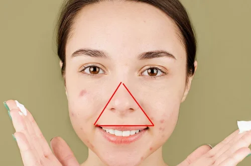 Popping Pimples: Why You Shouldn't and How to Do It Safely (If You Must)