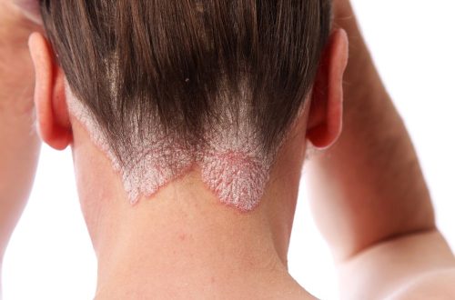 Seborrheic Dermatitis: The Scalp Condition Behind Many Dandruff Cases