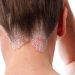 Seborrheic Dermatitis: The Scalp Condition Behind Many Dandruff Cases