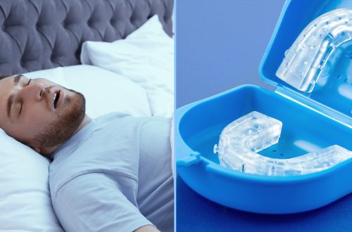 Mandibular Advancement Devices (MADs): Pros and Cons